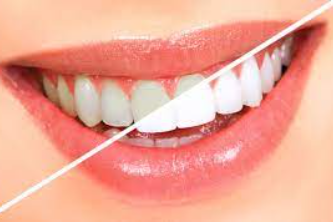 Teeth Whitening